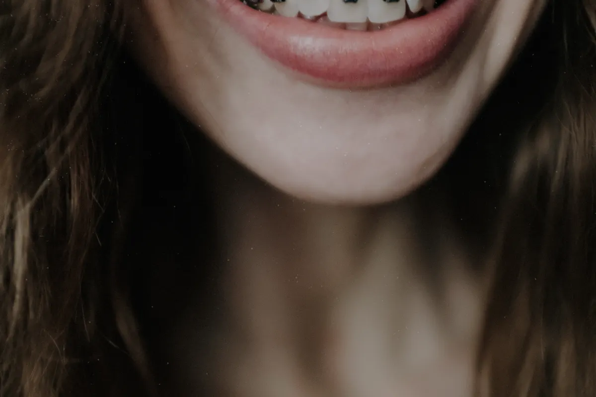 Sourire d'une patiente portant un appareil orthodontique