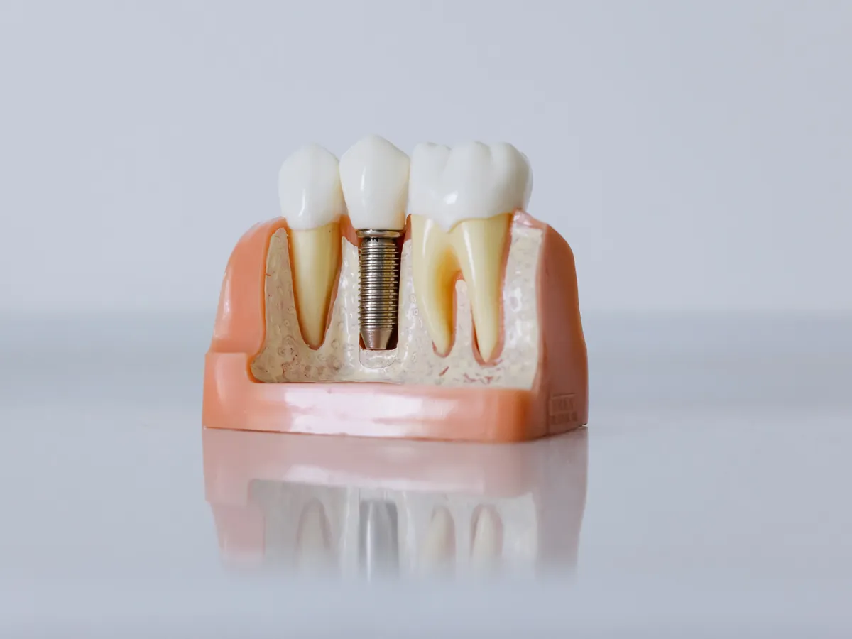 Maquette d'implant dentaire avec couronne